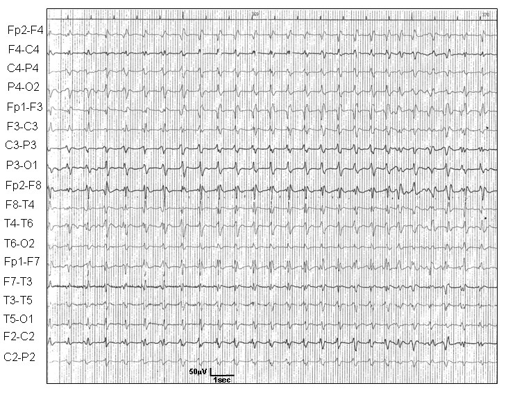Eletroencefalograma mostrando ondas trifásicas periódicas características da doença de Creutzfeldt-Jakob