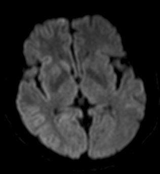 Ressonância magnética mostrando alterações cerebrais típicas da doença de Creutzfeldt-Jakob